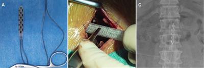 Hypertrophy of paravertebral muscles after epidural electrical stimulation shifted: A case report